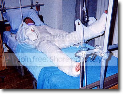 full-body-cast.jpg